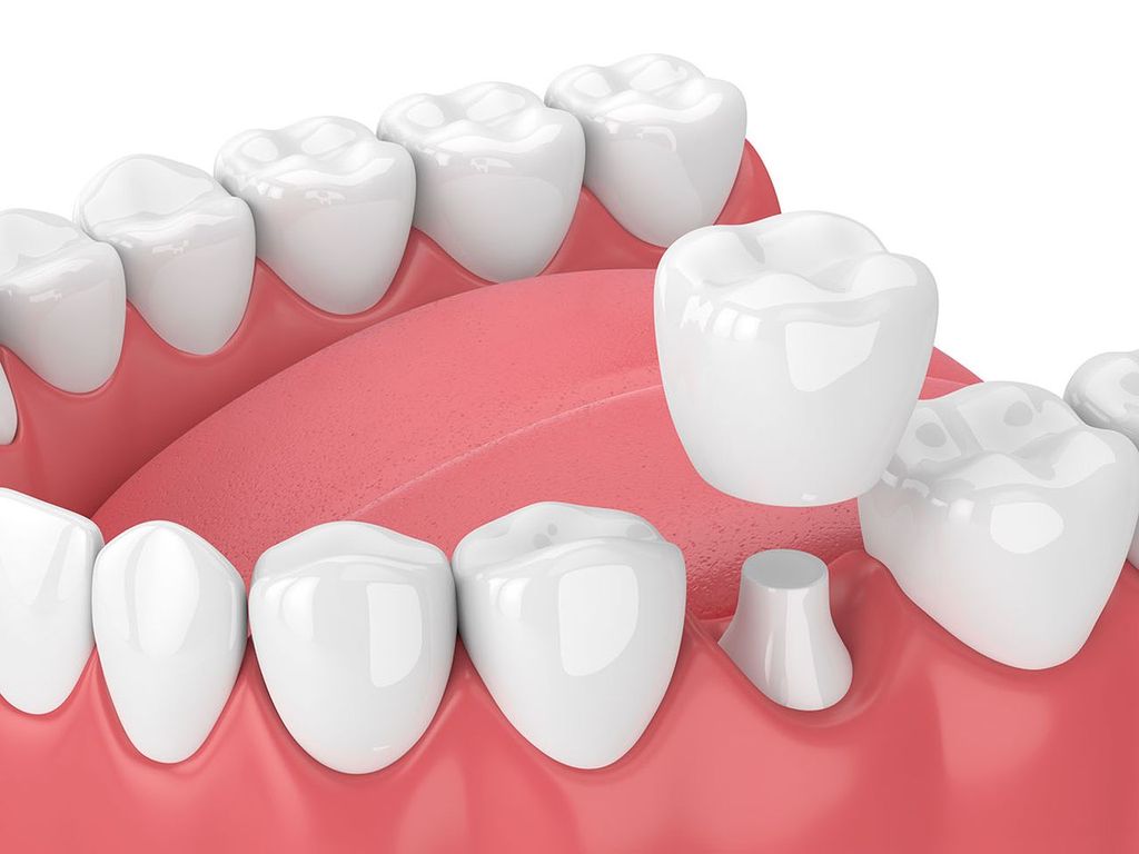 All About the Dental Crown Procedure