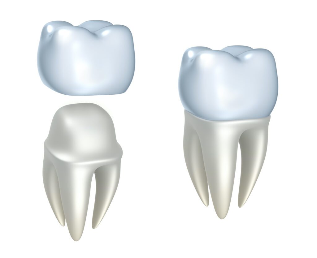 Dental crowns often play a pivotal role in restorative dentistry, offering both function and aesthetics for damaged or decayed teeth.