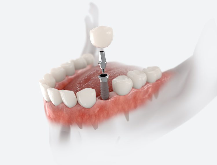 Understanding the benefits of dental implants and the situations in which they are most appropriate can guide your decision-making process.